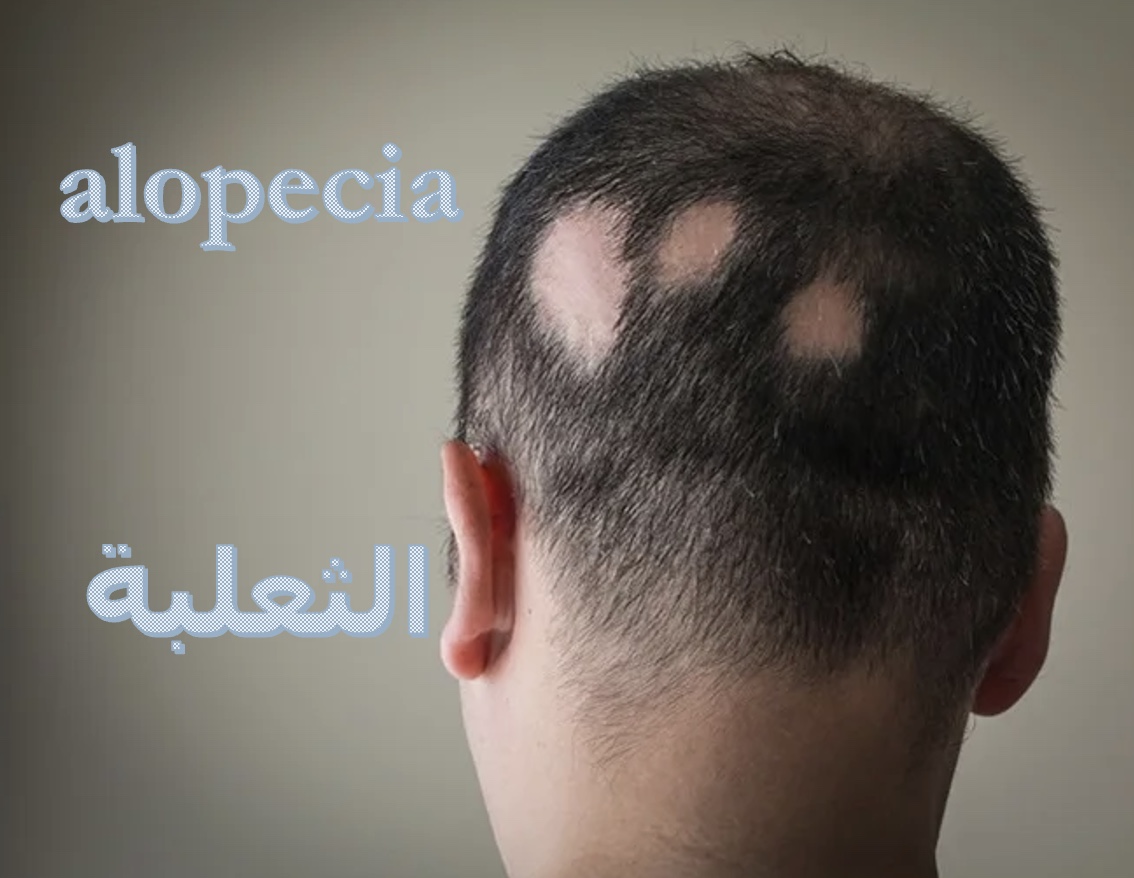 الثعلبة - الذئبة الحمراء - الروماتيزم بانواعه